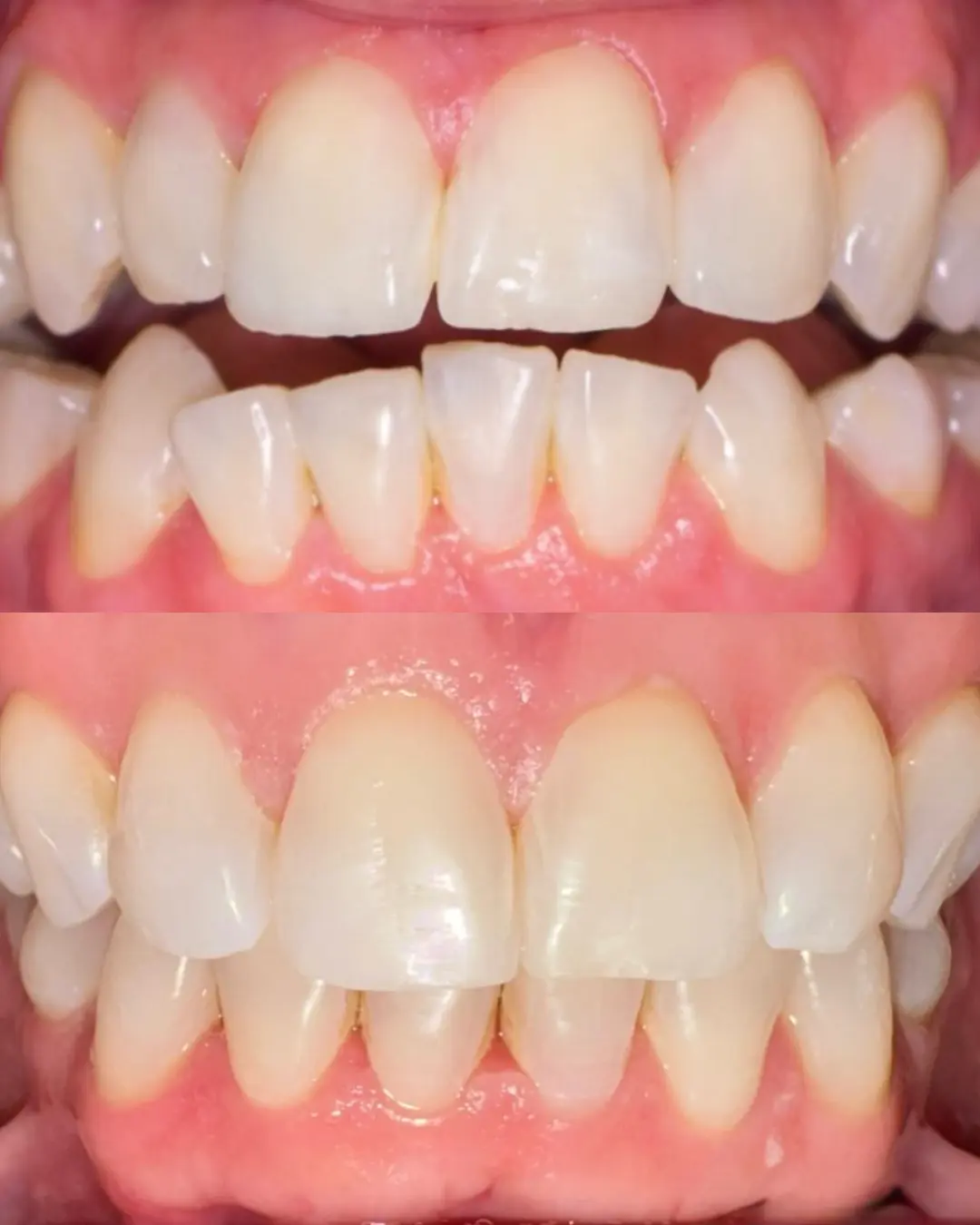 Clear aligners before and after