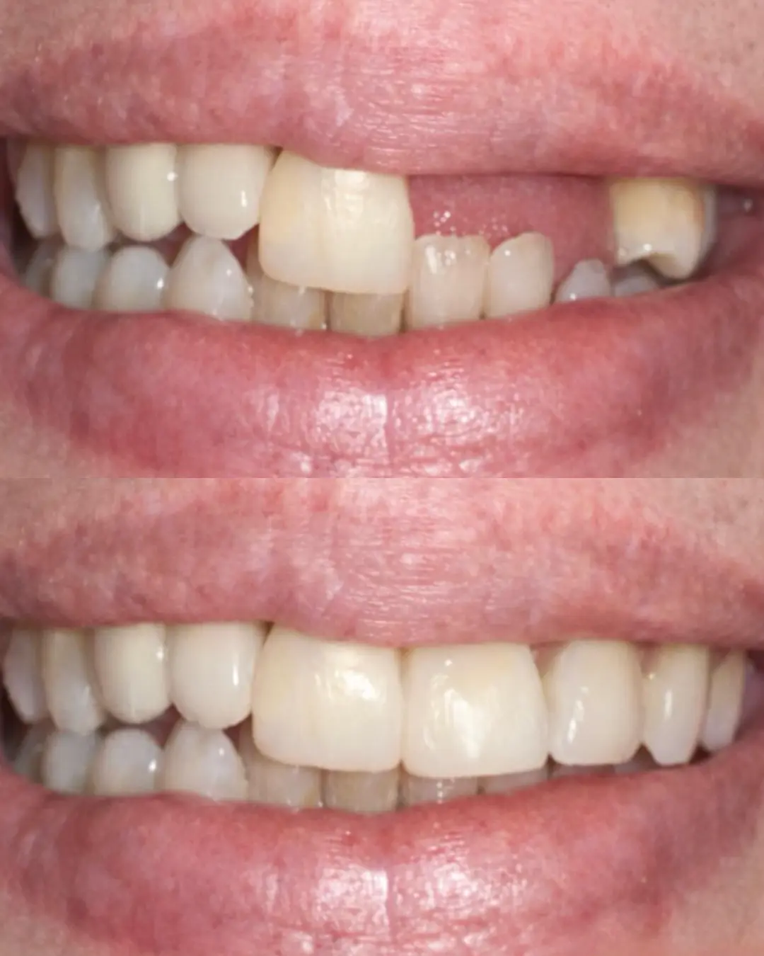 Dental implants before and after