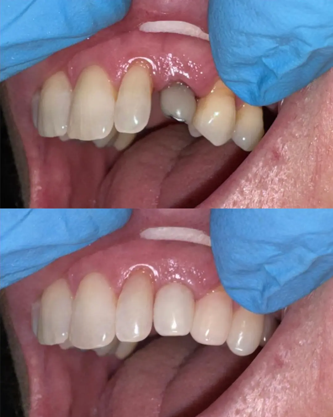 Dental restoration before and after